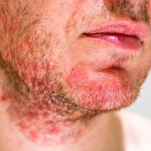 Bartflechte – Ursachen, Symptome, Behandlung & Vorbeugung